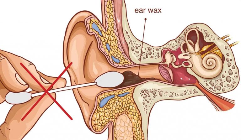 All About Ear Wax | Microsuction Ear Wax Removal Bedford